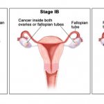 3 стадии рака яичников и маточной трубы