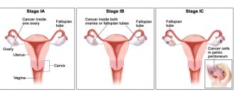 3 стадии рака яичников и маточной трубы