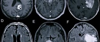 Астроцитома головного мозга: причины, симптомы, лечение, прогноз