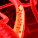 Atherosclerotic cardiosclerosis