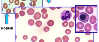 B12 anemia