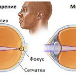 Myopia (myopia) causes