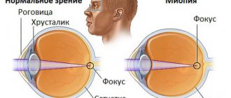 Myopia (myopia) causes