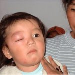 Chagas disease - symptoms and treatment, photos and videos.