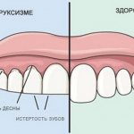 Bruxism in adults