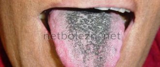 Black coating on the tongue