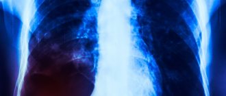 What is emphysema?