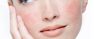 what is rosacea on the face