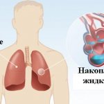What is pulmonary edema