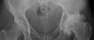 Deforming arthrosis of the hip joint