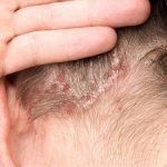 Dermatitis of the scalp