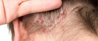 Dermatitis of the scalp