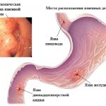 Endoscopic picture of peptic ulcer.