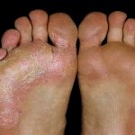 epidermophilia of the feet