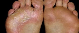 epidermophilia of the feet