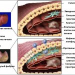 Liver fibrosis visual illustration