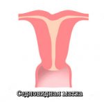uterine shape