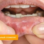 Photo of bacterial stomatitis