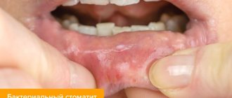 Photo of bacterial stomatitis