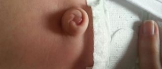 Photo of a large umbilical hernia in a child