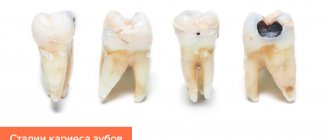 Photos of stages of dental caries