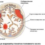 Brain hematomas