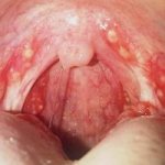 Pus in the throat without fever, how to treat it. Causes of pus in the throat and plugs in the tonsils 