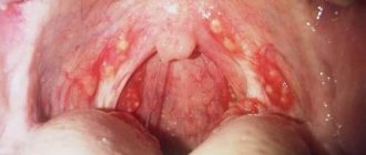 Pus in the throat without fever, how to treat it. Causes of pus in the throat and plugs in the tonsils 
