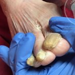 Nail fungus (onychomycosis): what you need to know about treatment and prevention?