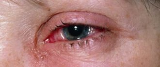 Eye infection