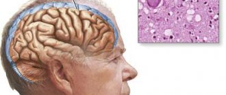 Изменения в головном мозге при болезни Крейтцфельдта–Якоба