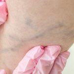 What does varicose veins look like?