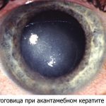 Кератит роговицы глаза - симптомы (признаки)