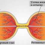 Классификация диабетической ретинопатии (стадии)