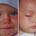 measles in children: rashes on the face