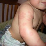 hives in a child photo