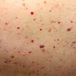 Red moles on the body