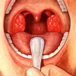 lacunar tonsillitis signs