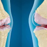 Treatment of arthrosis of the knee joint