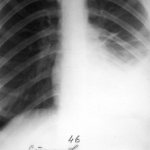 Left-sided pleurisy on x-ray