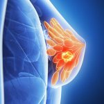 Breast mastopathy - symptoms and diagnosis. How to treat mastopathy? 