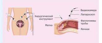 Treatment methods for functional cysts - Image No. 1