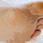 Mycosis of the feet: how does it manifest, how to treat?