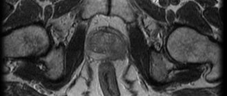 MRI (T2-weighted images) picture of the lesion in the left lobe of the prostate gland