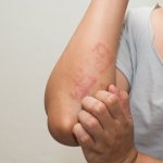 Нейродермит – хроническое кожное заболевание
