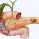 Exacerbation of pancreatitis: first aid for an attack