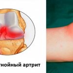 Acute purulent arthritis