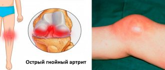 Acute purulent arthritis