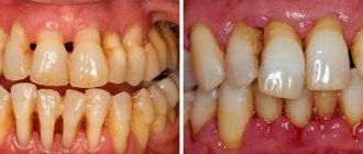 Periodontitis and periodontal disease