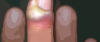 Paronychia - Inflammation around the nail: how to remove redness?